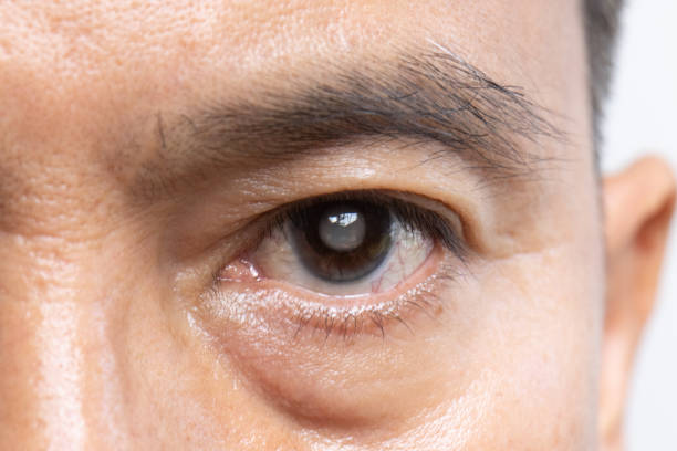 cost of cataract surgery for Gold Coast