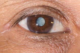 cataract-1